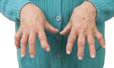 Remedios caseros para la artritis