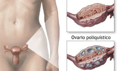 Cómo eliminar los quistes en los ovarios